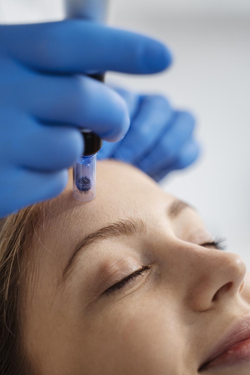 Hydratation peau injections de Profhilo Angers injections de Profhilo Angers