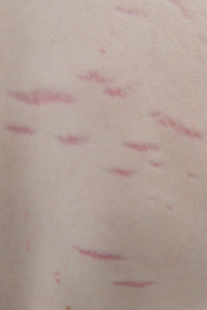 traitement vergetures laser c02 Angers traitement vergetures laser c02 Angers